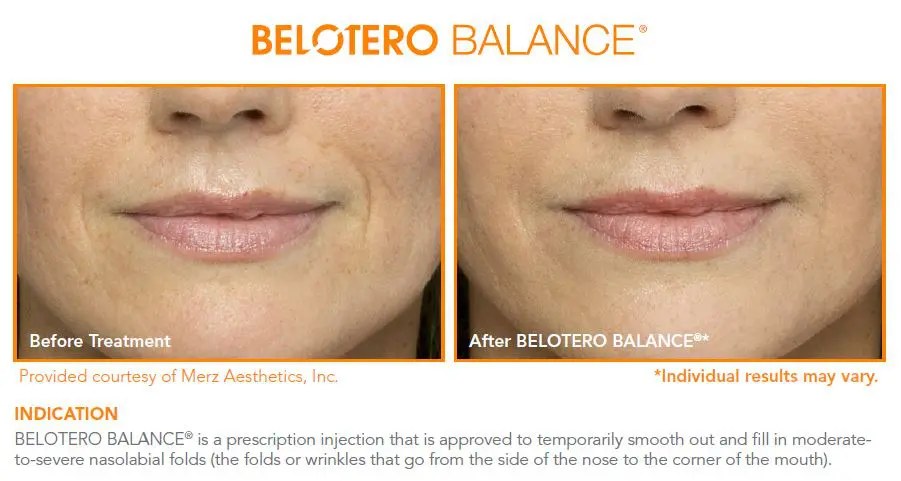 Belotero-2 Belotero® in Indianapolis, Indiana