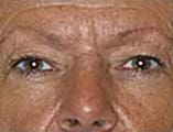 Blepharoplasty Before and After Pictures Indianapolis, IN