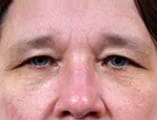 Blepharoplasty Before and After Pictures Indianapolis, IN