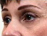 Blepharoplasty Before and After Pictures Indianapolis, IN