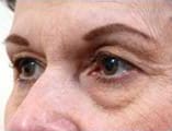 Blepharoplasty Before and After Pictures Indianapolis, IN