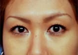 Blepharoplasty Before and After Pictures Indianapolis, IN