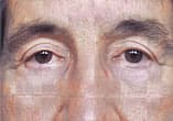 Blepharoplasty Before and After Pictures Indianapolis, IN