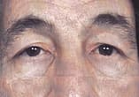 Blepharoplasty Before and After Pictures Indianapolis, IN