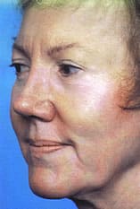 Facelift Before and After Pictures Indianapolis, IN