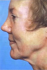Facelift Before and After Pictures Indianapolis, IN