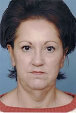 Facelift Before and After Pictures Indianapolis, IN