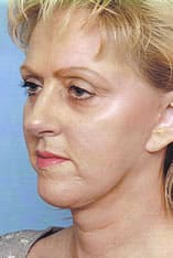 Facelift Before and After Pictures Indianapolis, IN