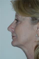 Facelift Before and After Pictures Indianapolis, IN