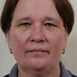 Facelift Before and After Pictures Indianapolis, IN
