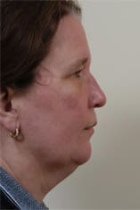 Facelift Before and After Pictures Indianapolis, IN
