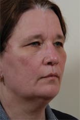Facelift Before and After Pictures Indianapolis, IN