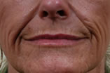 Laser Resurfacing Before and After Pictures Indianapolis, IN