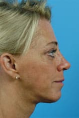 Facelift Before and After Pictures Indianapolis, IN