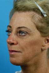Facelift Before and After Pictures Indianapolis, IN