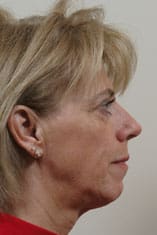 Facelift Before and After Pictures Indianapolis, IN