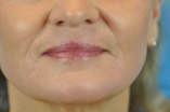 Laser Resurfacing Before and After Pictures Indianapolis, IN