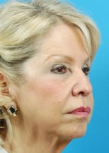 Facelift Before and After Pictures Indianapolis, IN