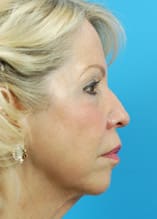 Facelift Before and After Pictures Indianapolis, IN