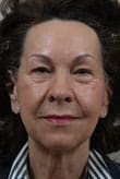 Facelift Before and After Pictures Indianapolis, IN