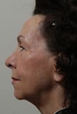 Facelift Before and After Pictures Indianapolis, IN