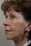 Facelift Before and After Pictures Indianapolis, IN