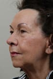 Facelift Before and After Pictures Indianapolis, IN