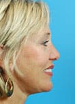 Facelift Before and After Pictures Indianapolis, IN