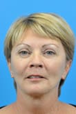 Facelift Before and After Pictures Indianapolis, IN