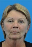 Facelift Before and After Pictures Indianapolis, IN