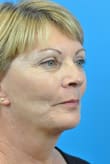 Facelift Before and After Pictures Indianapolis, IN