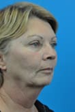 Facelift Before and After Pictures Indianapolis, IN