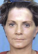 Facelift Before and After Pictures Indianapolis, IN