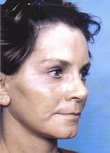 Facelift Before and After Pictures Indianapolis, IN