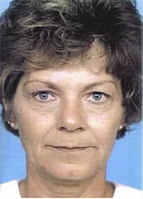 Facelift Before and After Pictures Indianapolis, IN