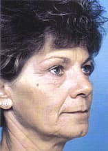 Facelift Before and After Pictures Indianapolis, IN