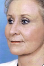 Facelift Before and After Pictures Indianapolis, IN