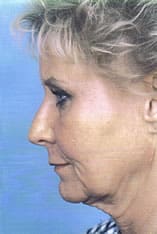 Facelift Before and After Pictures Indianapolis, IN