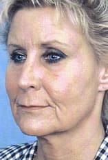Facelift Before and After Pictures Indianapolis, IN