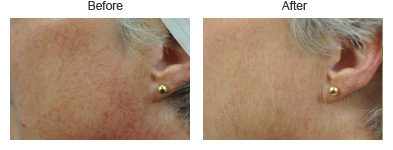 Laser Resurfacing in Indianapolis, IN