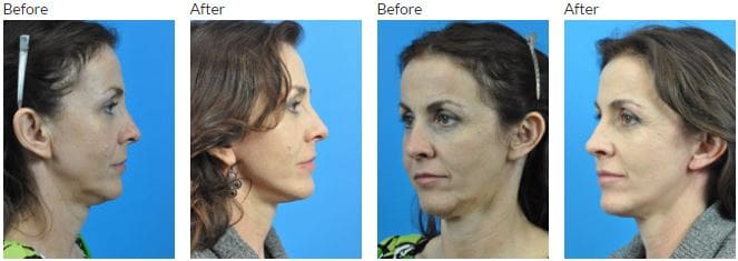 Mini Face Lift Before and After Pictures Indianapolis, IN