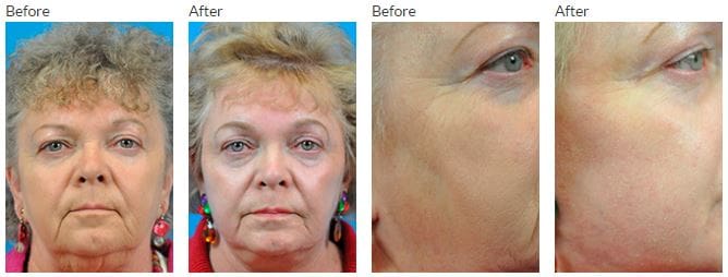 Fractional Laser Resurfacing Before and After Pictures Indianapolis, IN