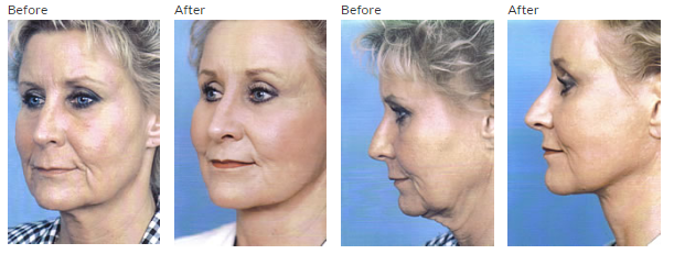 Facelift Before and After Pictures Indianapolis, IN