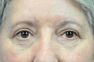 Blepharoplasty Before and After Pictures Indianapolis, IN