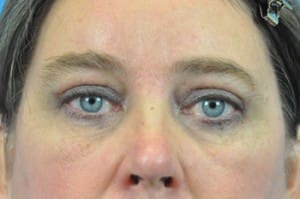 Brow Lift Before and After Pictures Indianapolis, IN