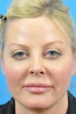 Neck Lift Before and After Pictures Indianapolis, IN