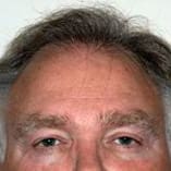 Hair Transplant Before and After Pictures Indianapolis, IN