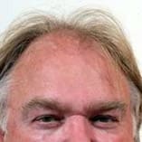 Hair Transplant Before and After Pictures Indianapolis, IN