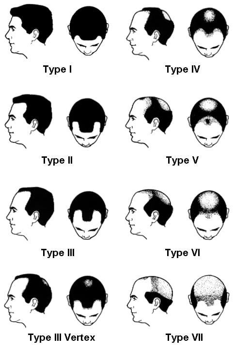 Male Pattern Baldness in Indianapolis, IN