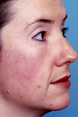 Skin Cancer Reconstruction Before and After Pictures Indianapolis, IN